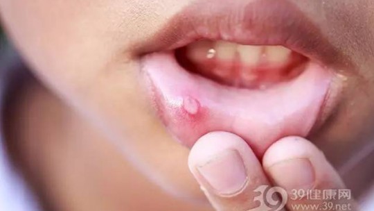 冬季“干燥上火”导致口腔溃疡？四个细节要注意